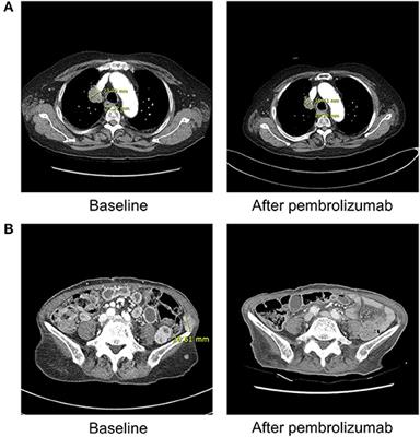 Immune Checkpoint Inhibitor-Induced Diabetic Ketoacidosis: A Report of Four Cases and Literature Review